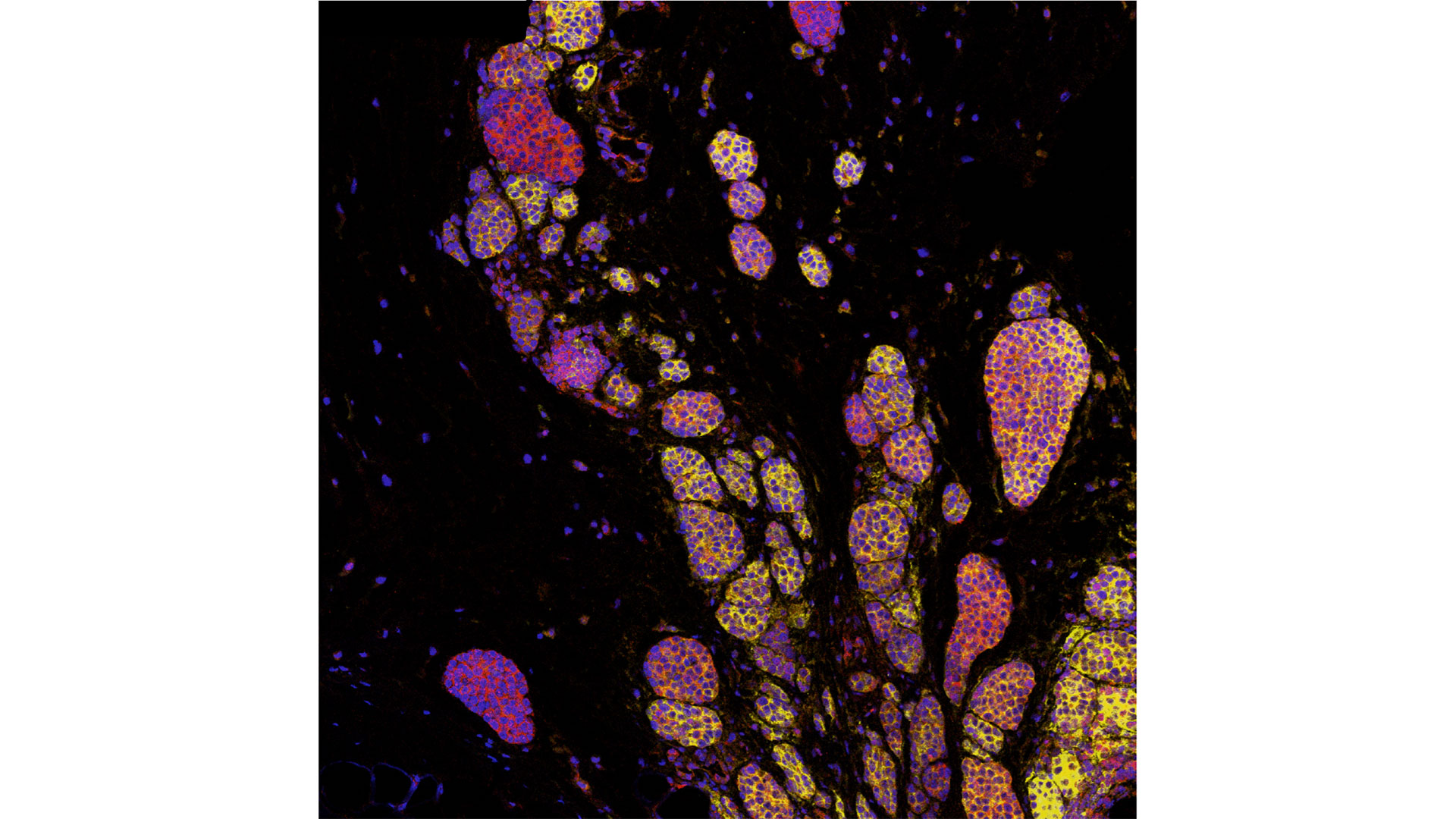 Image of a melanoma tumor