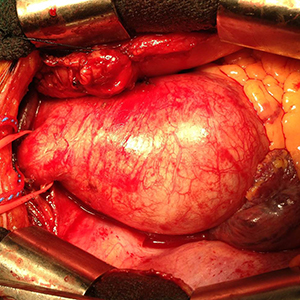 Ascending aortic aneurysm