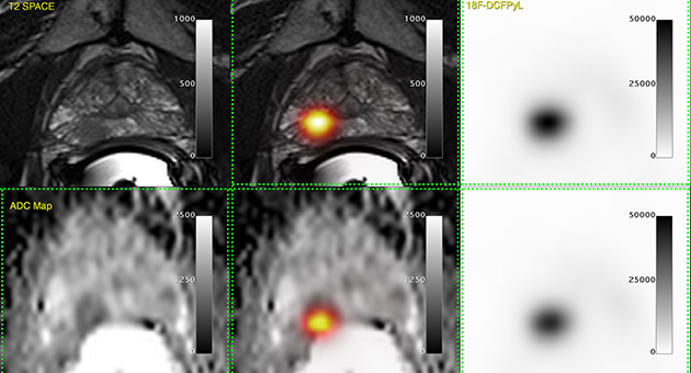 Images from scans using PSMA probe