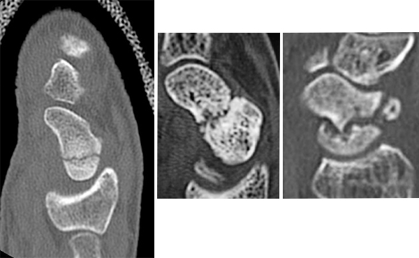 X-rays of scaphoid fracture